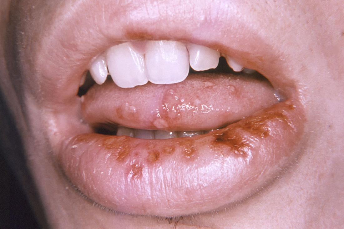 Oral venereal disease mouth penis