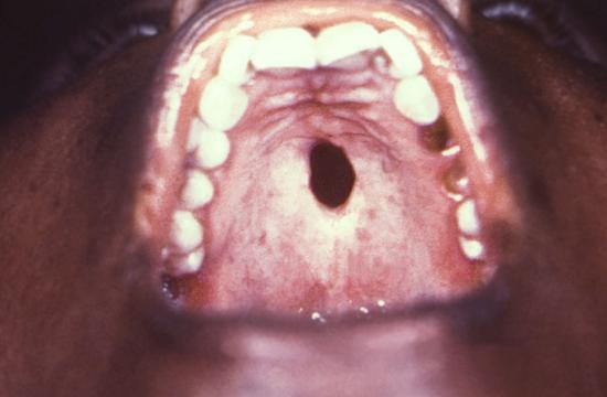 chlamydia mouth sores