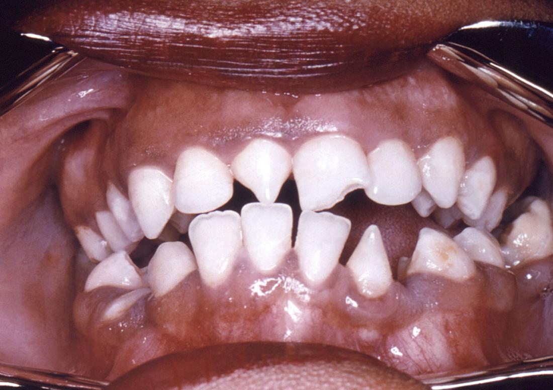 syphilis causing deformity of teeth. Image credit: CDC/ Robert E. Sumpter, 1967.