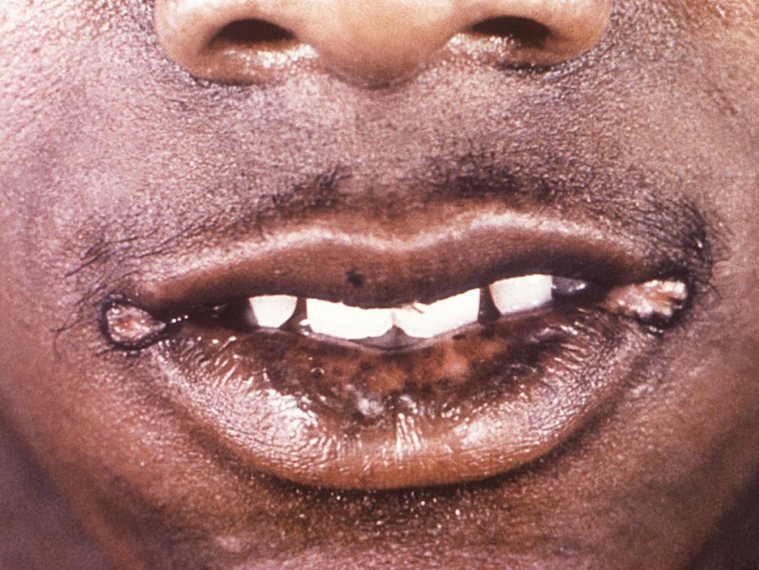 Syphilis causing papules around mouth. Image credit: CDC/ Robert E. Sumpter, 1967.