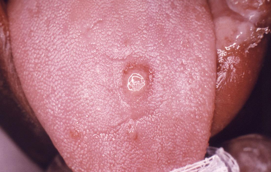 gonorrhea on tongue