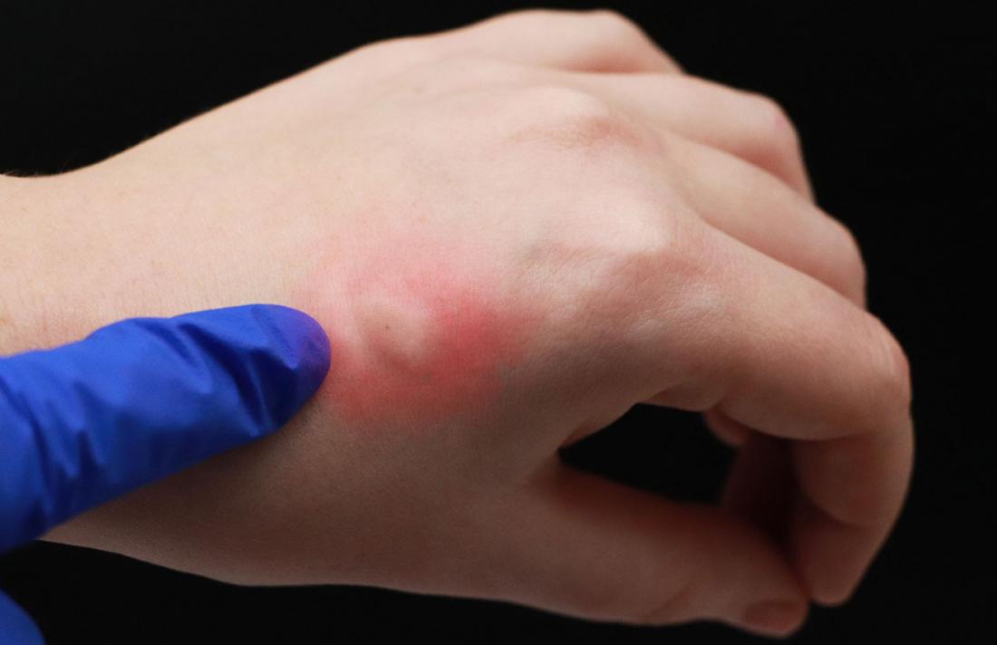 What are the symptoms of an allergic reaction to a mosquito bite