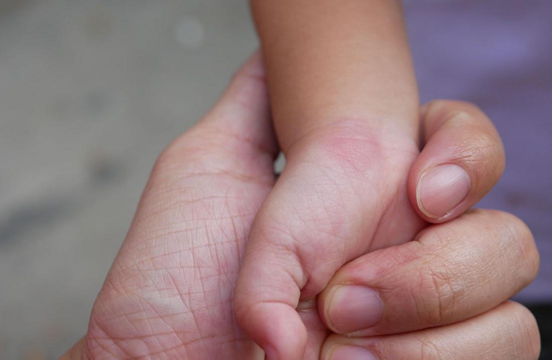 Allergic reaction to bug bites in childrenpictures