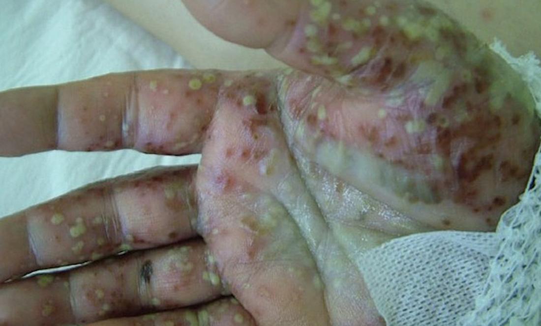 Acropustulosis. Image credit: Indian Journal of Dematology.