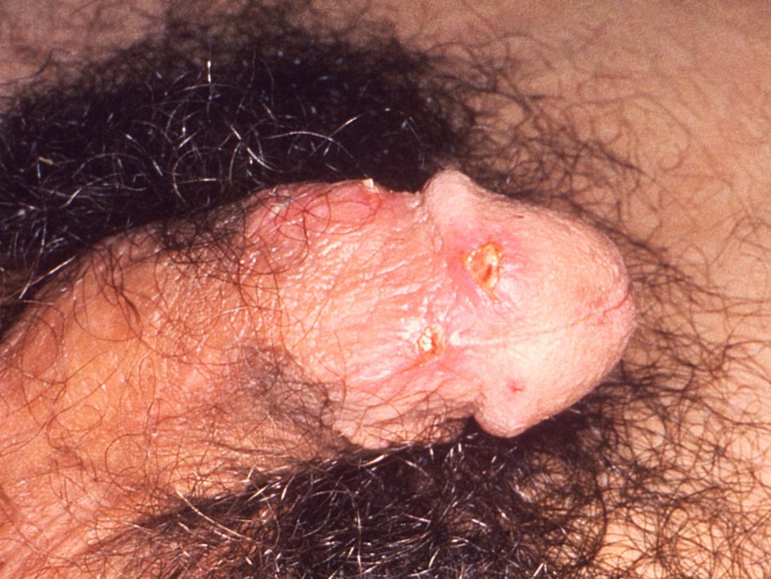 Balanitis <br>Image credit: CDC/ Dr. N. J. Fiumara, 1976</br>