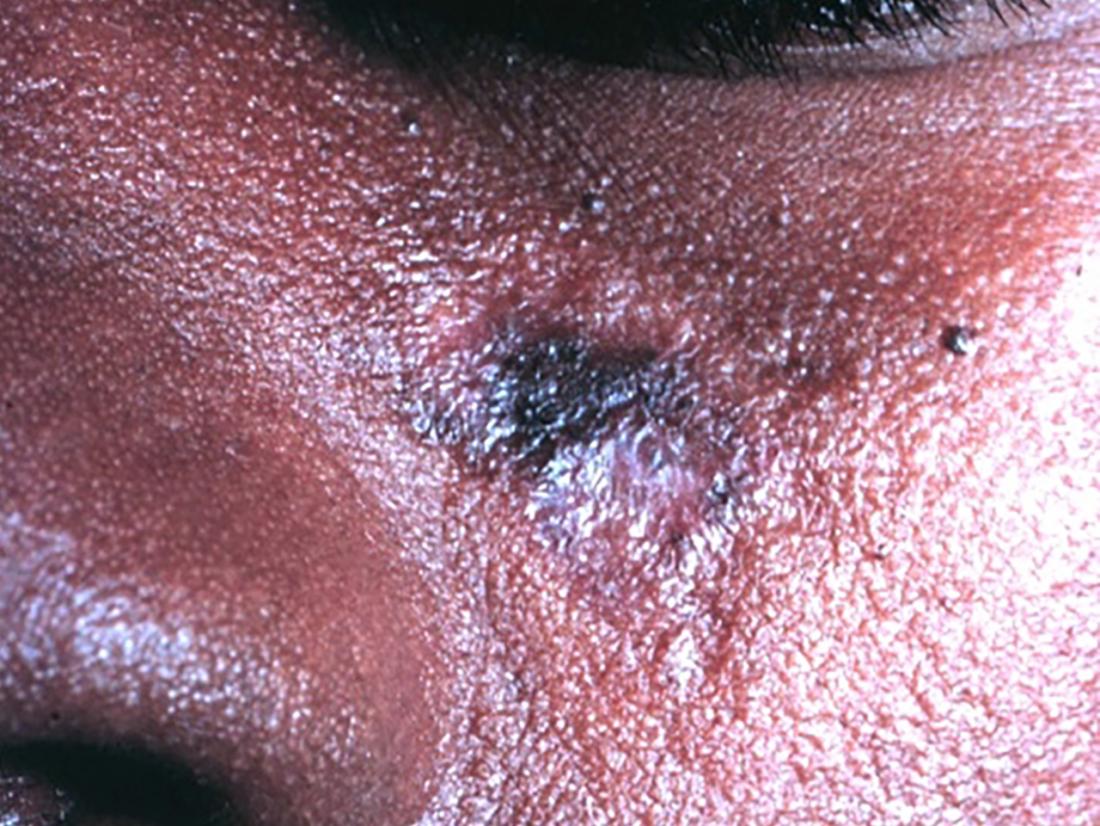 nasal ulcers lupus