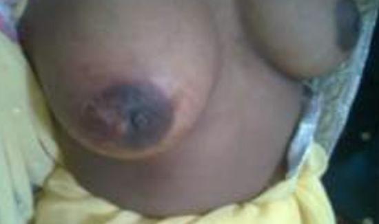 lump on areola. Image C<!--mce:protected %0A-->credit: Tiwari, P., & Tiwari, M., Sch. J. App. Med. Sci., 2013.
