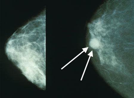 Mammogram of breast cancer. Image Credit: Bakerstmd, 2015.