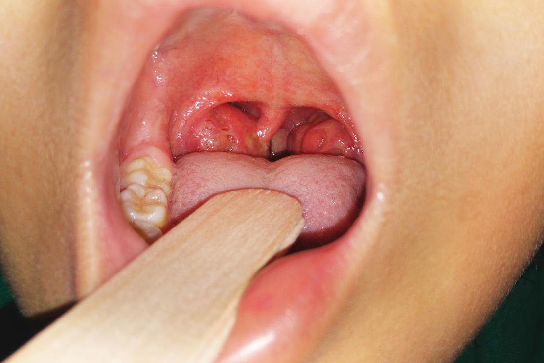 man with tonsillitis