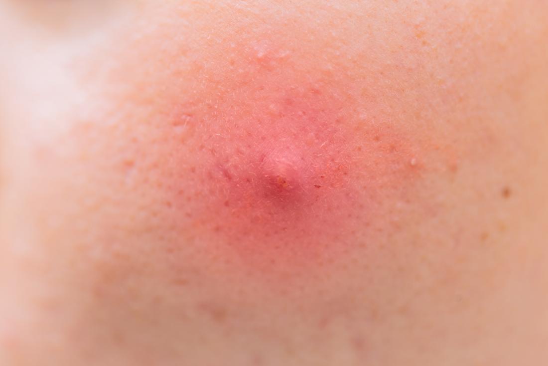 Armpit pimple: Types, causes, and treatments