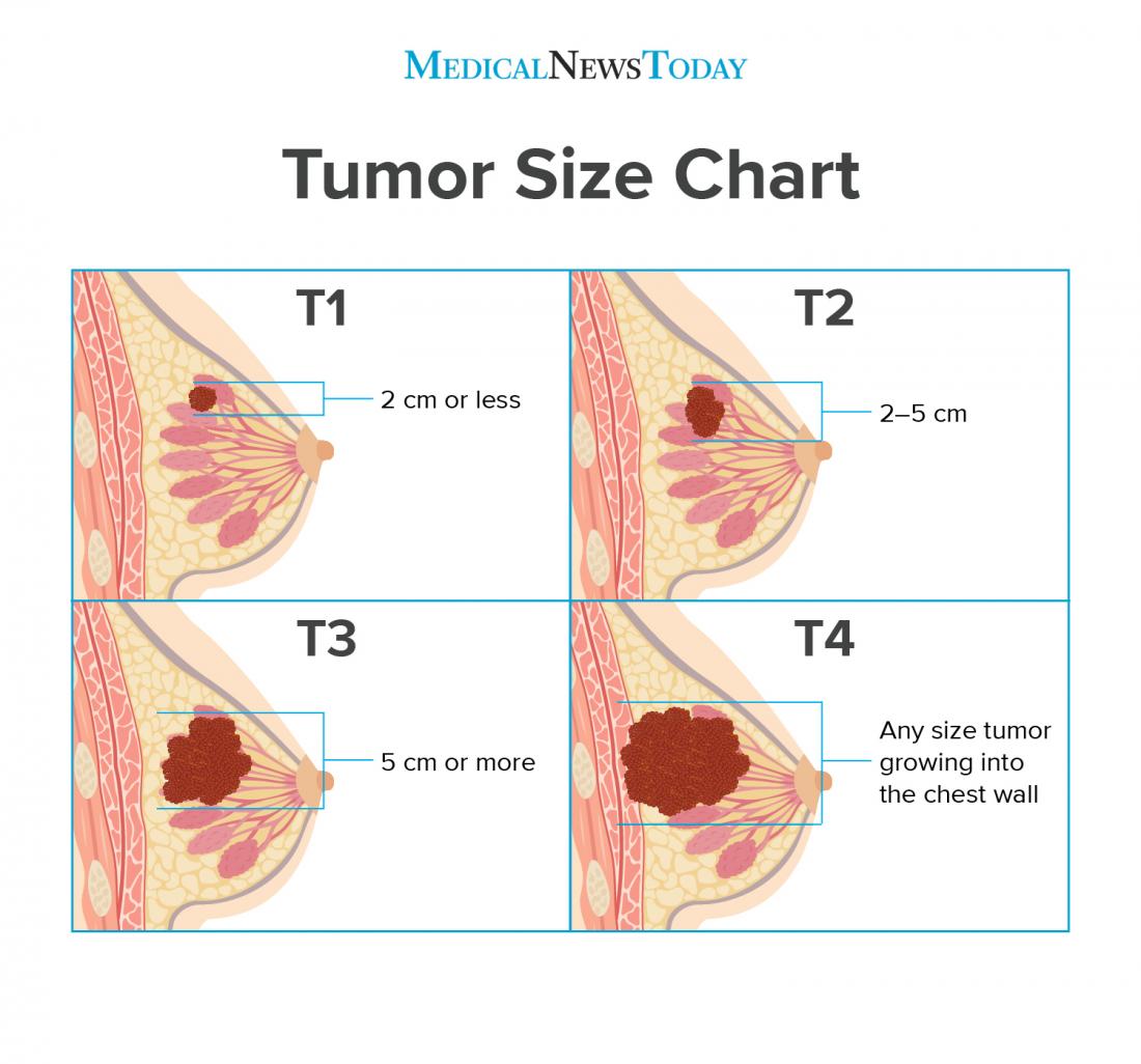 Benign Brain Tumor Size Chart