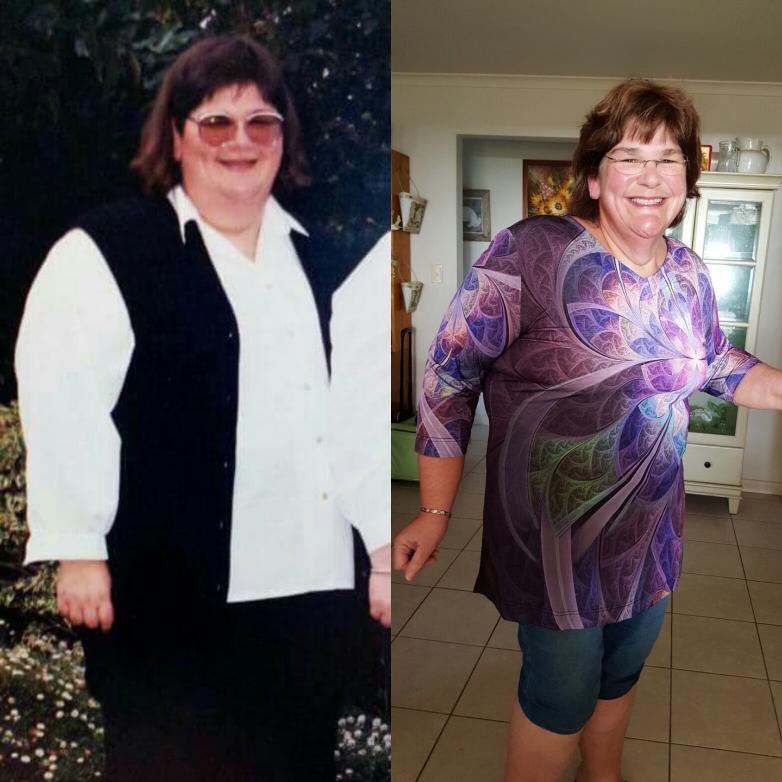 Transformation Through Gastric Sleeve Surgery Fuels Hope for a