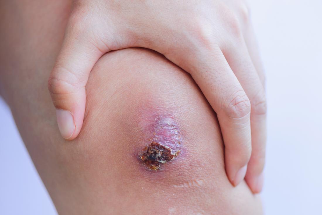 Infected scab: to and infections