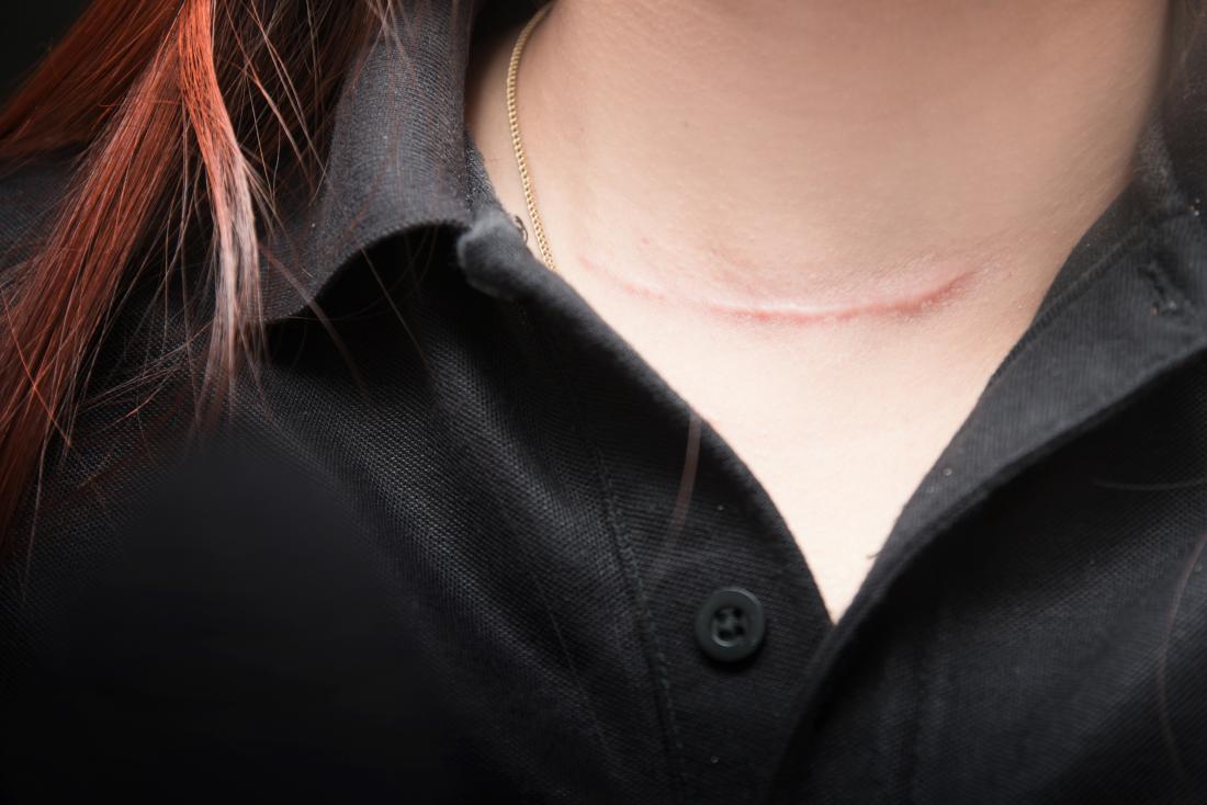 young woman with scar on neck