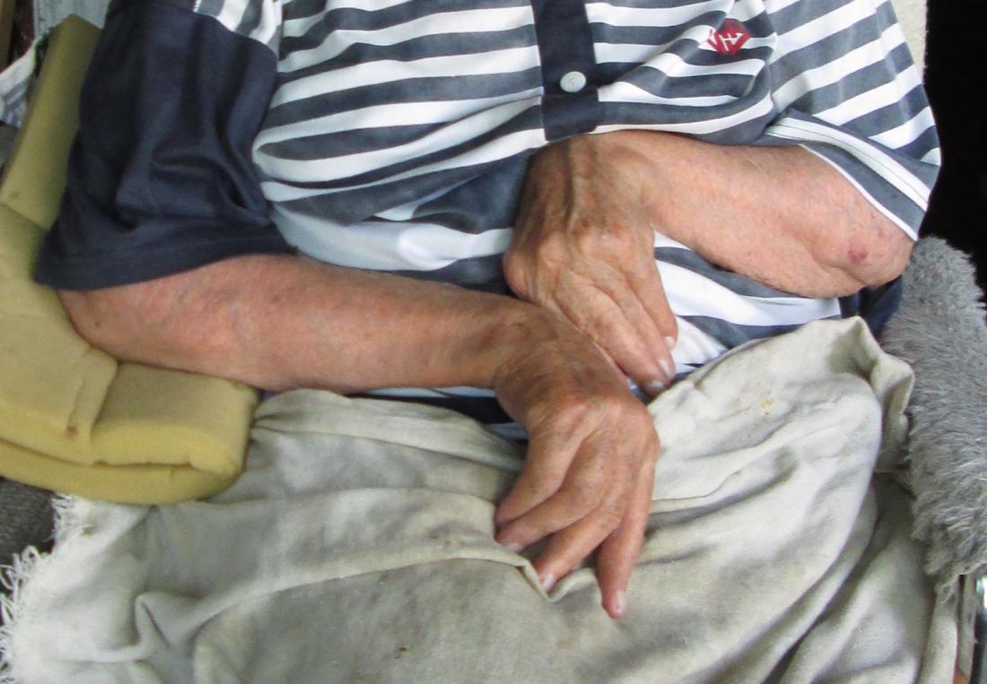 Ulnar deviation in person with rheumatoid arthritis. Image credit: Aljeannoir, 2015.
