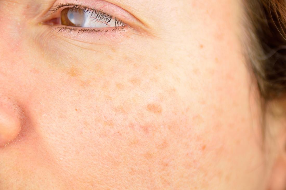 Scientists Discover Pathway To Skin Regeneration