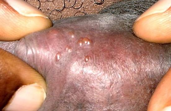 Genital herpes. Image credit: Grook Da Oger, 2010.