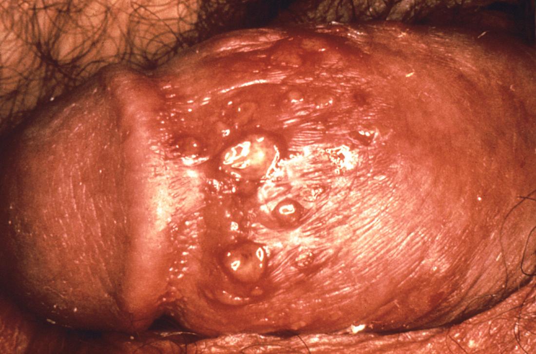 Herpes on penis. Image credit: CDC/ N. J. Flumara, Dr. Gavin Hart, 1976.