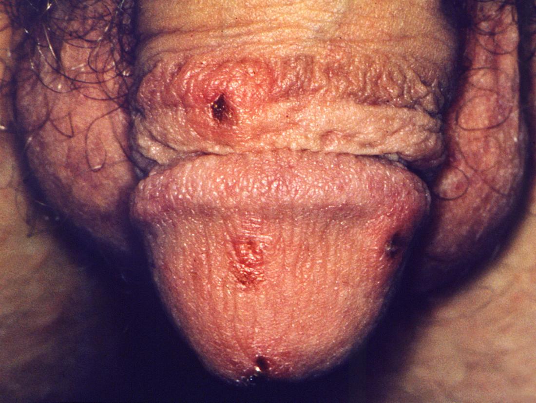 Scabies on penis. Image credit: CDC/ M. Rein, MD, University of Virginia, Susan Lindsley, 1975.