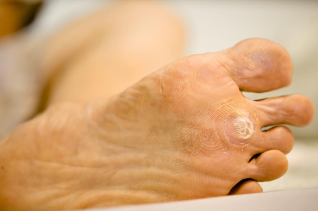 Can You Recognize Plantar Warts on Feet?