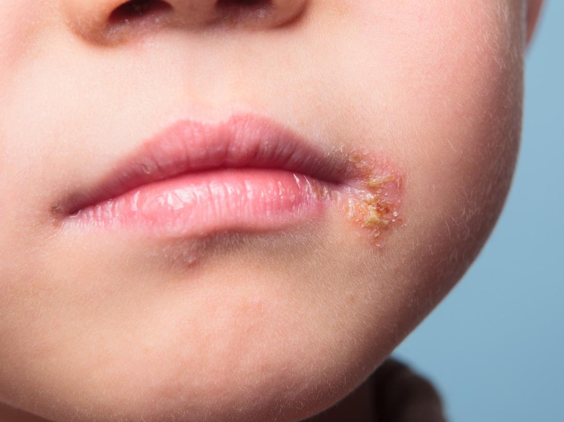 Heartwarming Info About How To Heal A Scab On Your Lip - Makepanic42