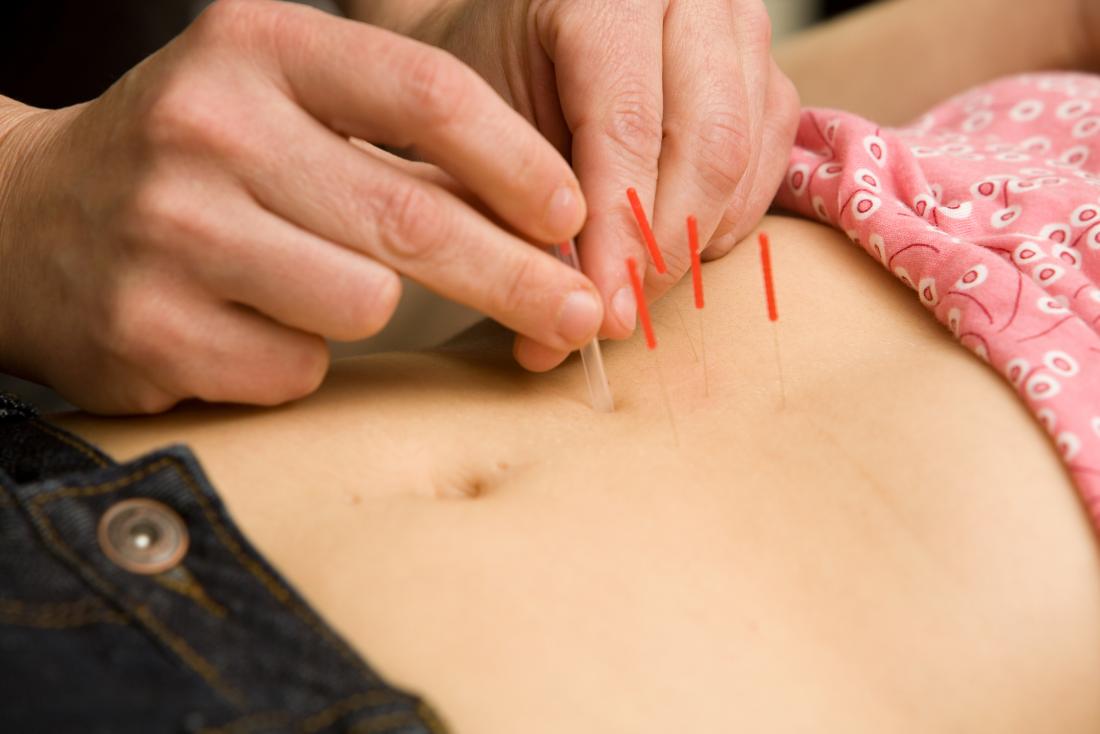 acupuncture being applied to persons stomach