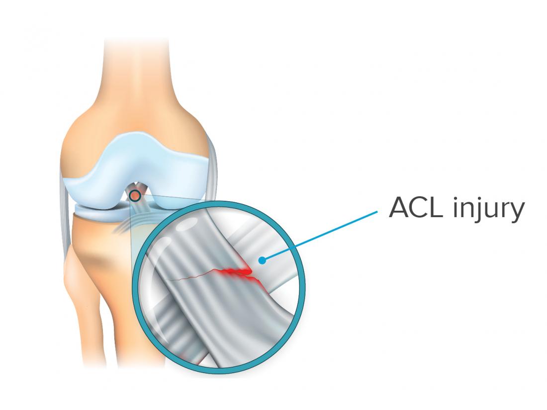 acl tear symptoms