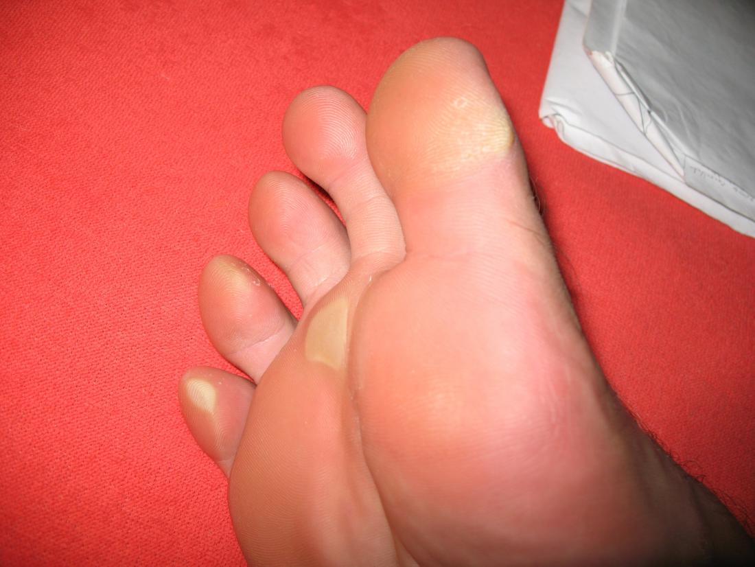 calluses on the foot. Image credit: Andrew Bossi, 2007