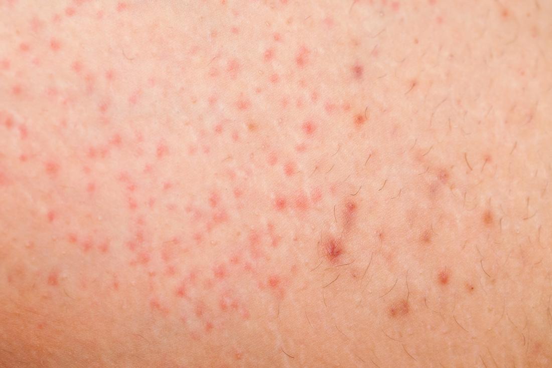 Armpit Rashes: 6 Causes, Symptoms, and How to Treat Them