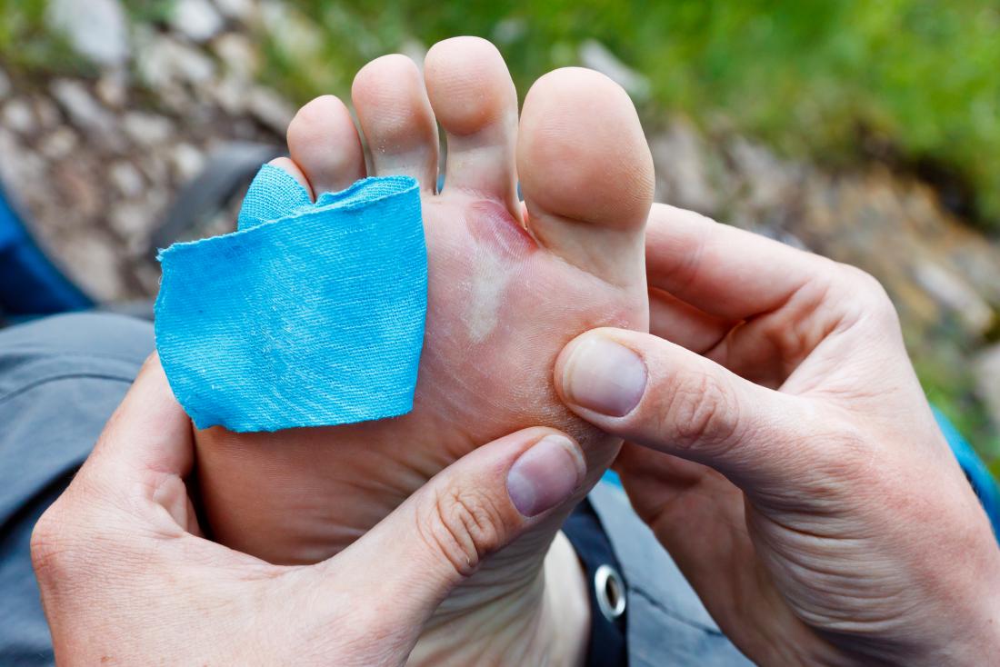 Should You Pop A Blister When To Do It Safe Methods And Tips   A Man Wondering Should You Pop A Blister 