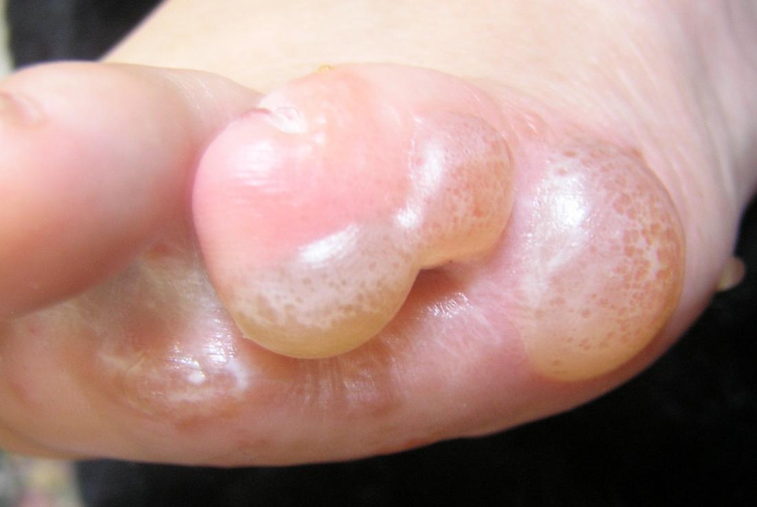 advanced stages of dyshidrotic eczema otherwise known as pompholyx. Image credit: Peter L Johnson, 2011.