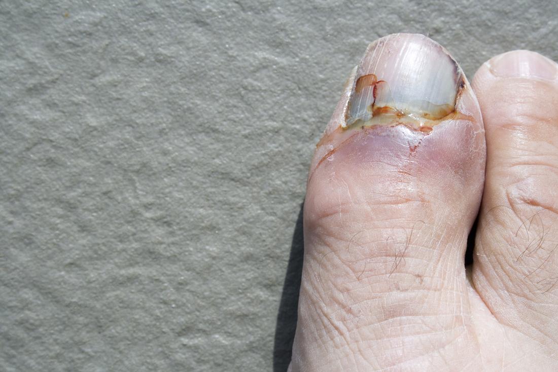 What Happens When Your Toe Nail Rips Off