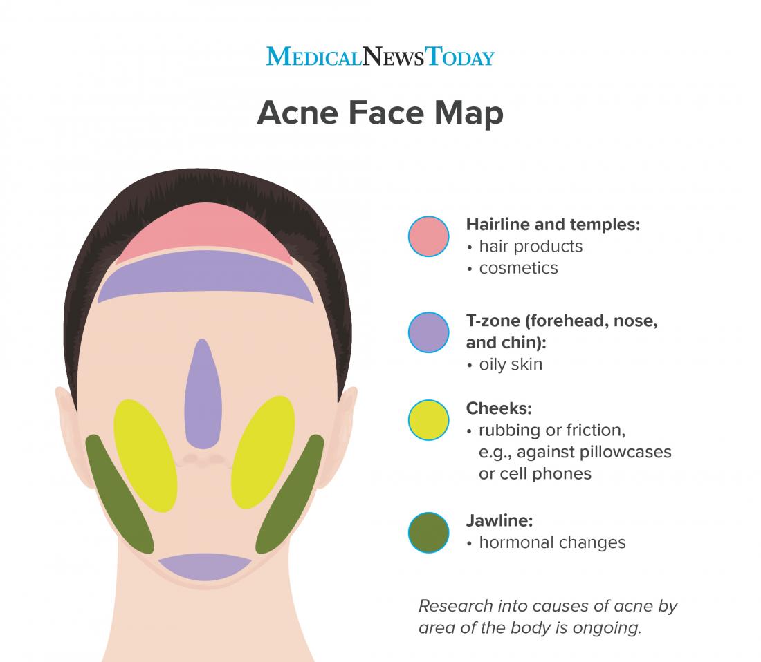 Acne Face Map Inforgraphic 