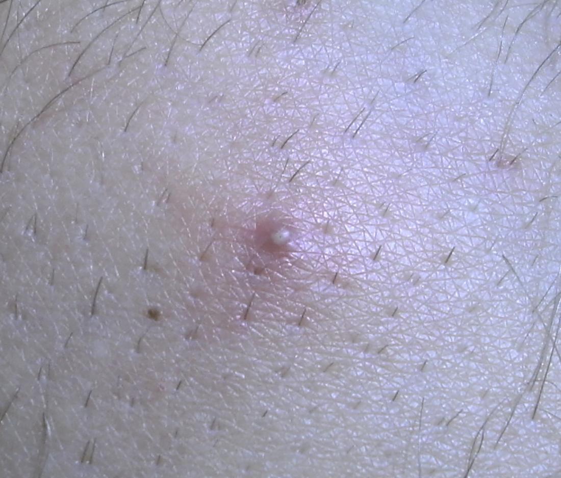 Ingrown Hair What It Looks Like Causes Treatment  Prevention