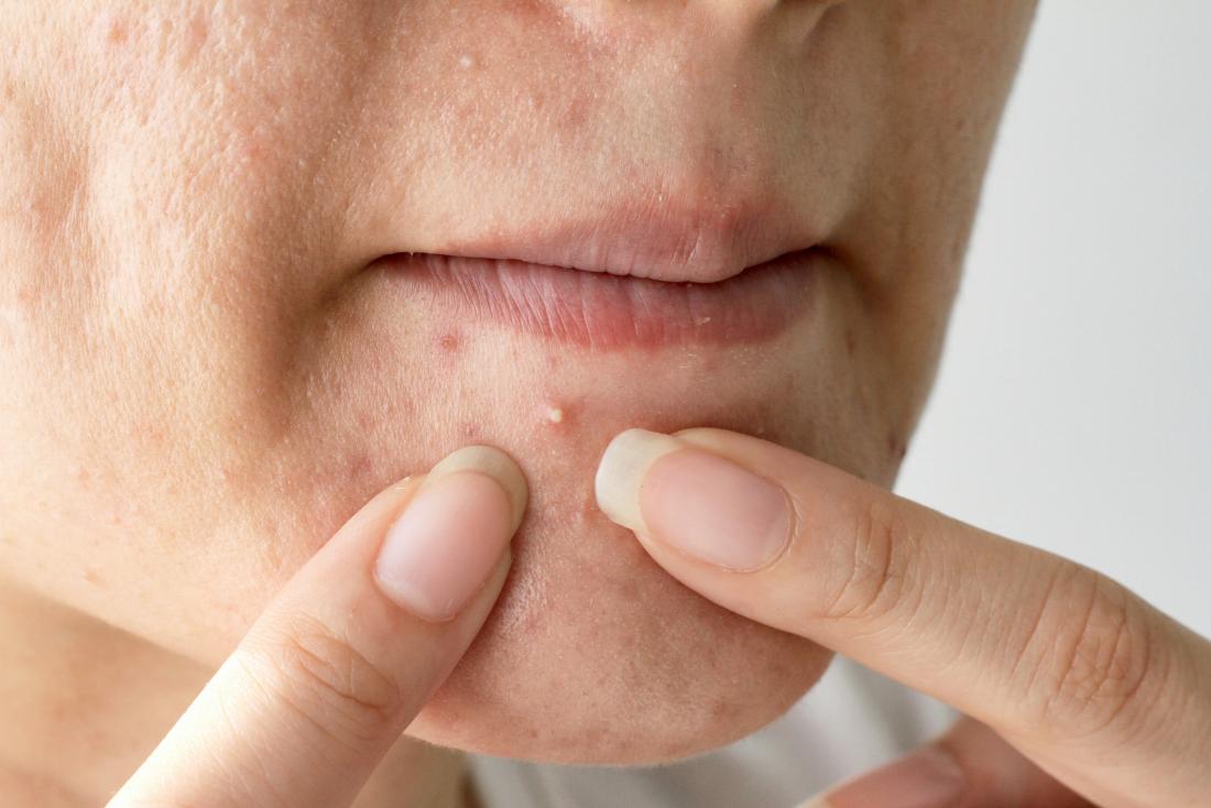 Pimples On The Chin What It Means And How To Get Rid Of Them