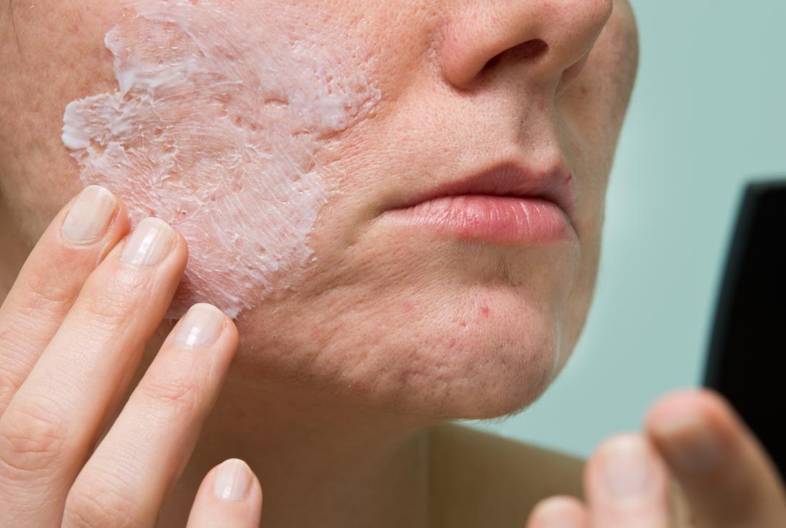 salicylic acid for acne