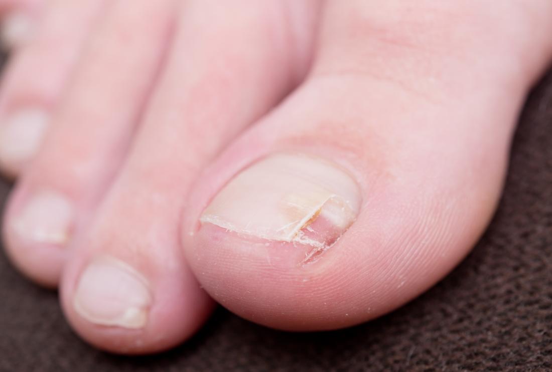 How To Fix A Split Nail Causes Treatment And Prevention