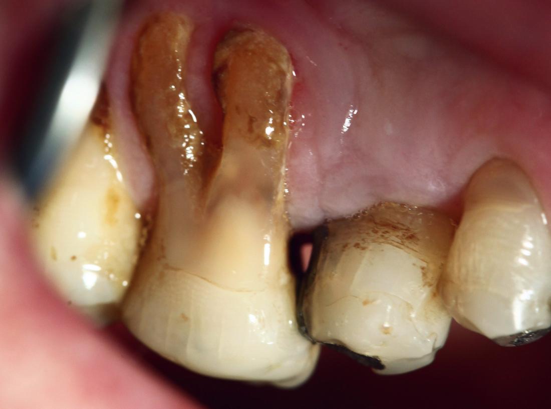 Swollen gum around one tooth Causes and treatment
