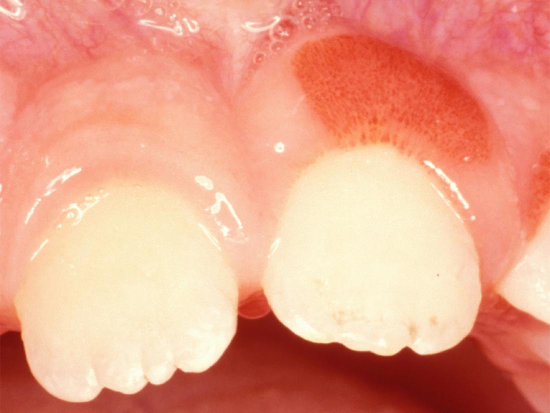 Swollen Gum Around One Tooth Causes And Treatment