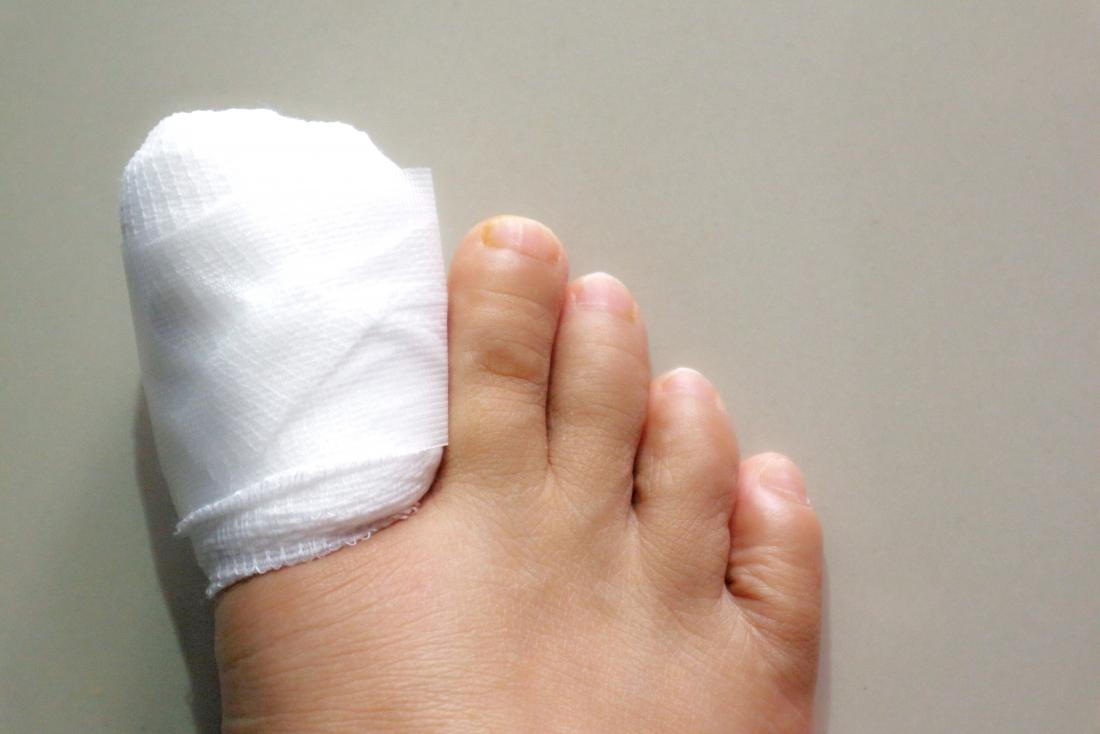 Surgery for ingrown toenails: Procedure, recovery, and risks