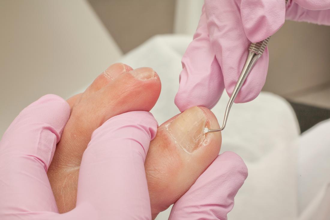 How To Cut Infected Ingrown Toenail