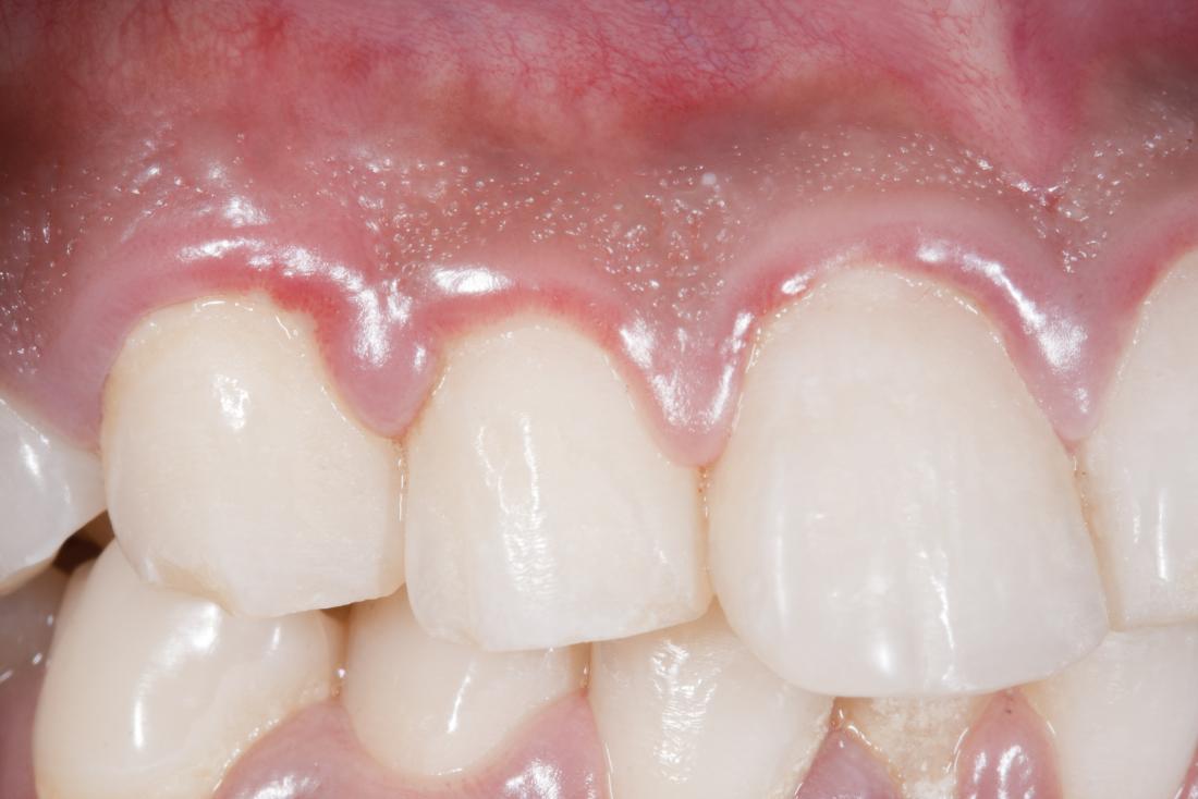 swollen gums caused by gingivitis