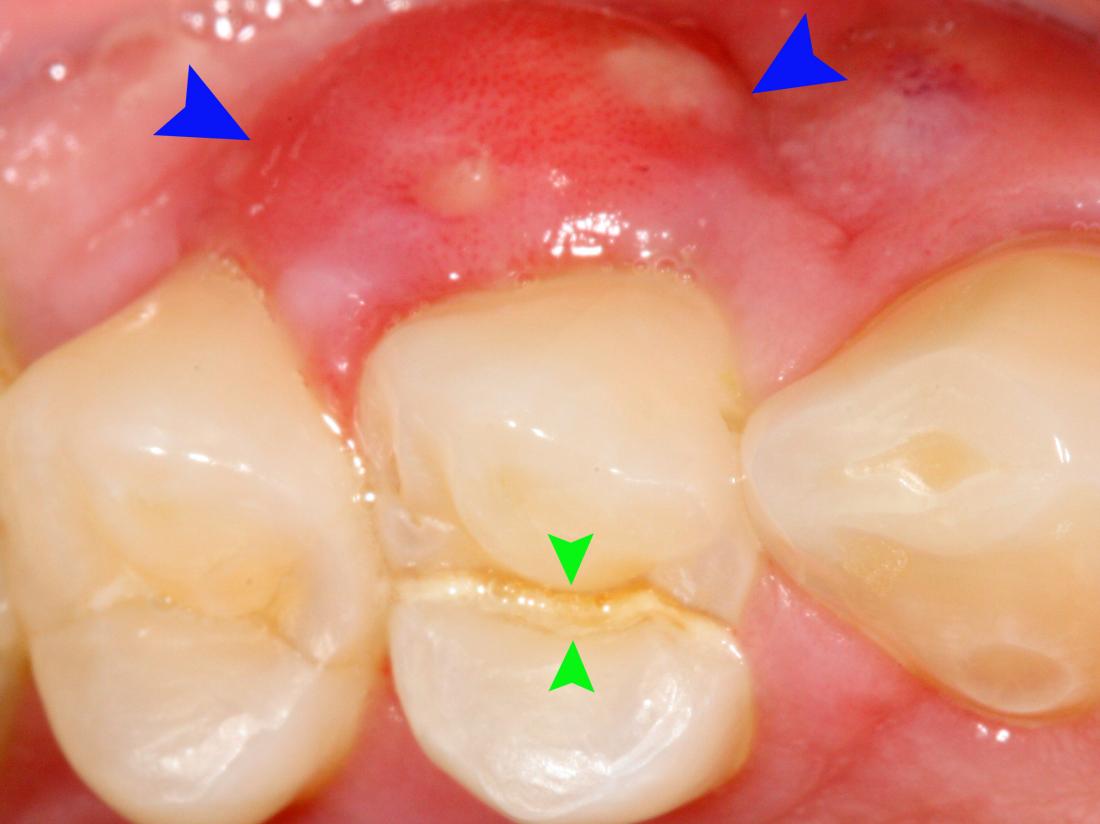 White Bumps On Gums   A Crack Of The Tooth And Root Splitting It In Two Even Pieces Which Has Caused A Lateral Periodontal Abscess Image Credit Coronation Dental Specialty Group 2014 