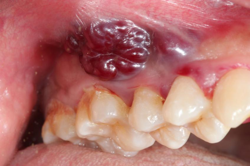 Extraction tooth bump site on tooth extraction