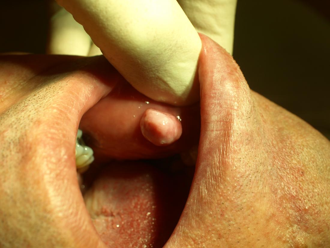 Fibroma of oral mucosa. Image credit: Klaus D. Peter, 2009
