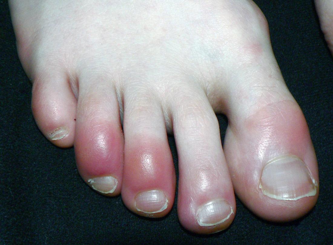 Red Toes that have Chilblains. Image credit: Sapp, 2019
