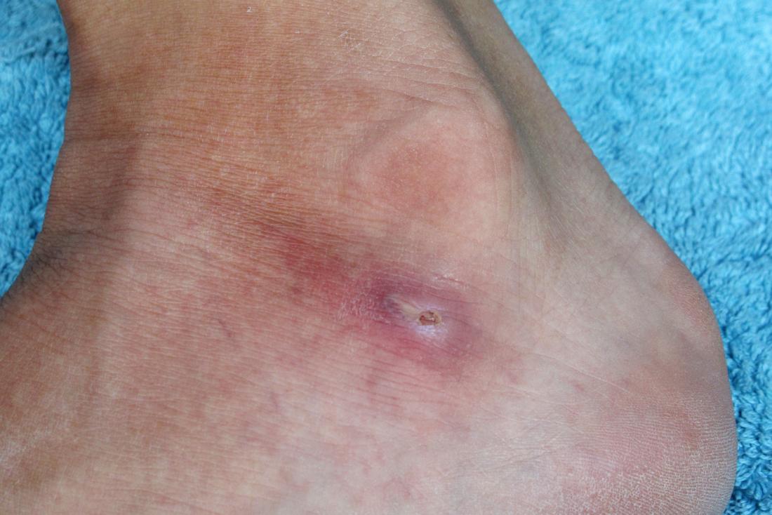 red dry skin on foot