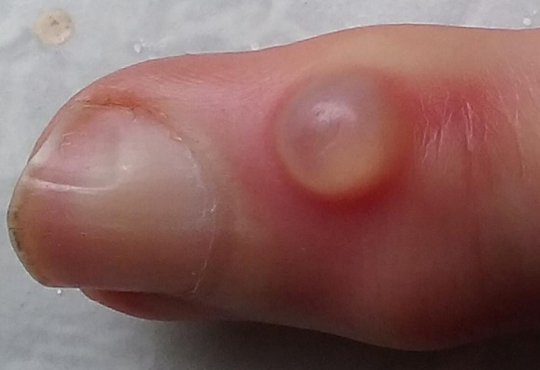 A Pimple on the finger caused by Digital mucous cyst. Image credit: Huge Bananas, 2015