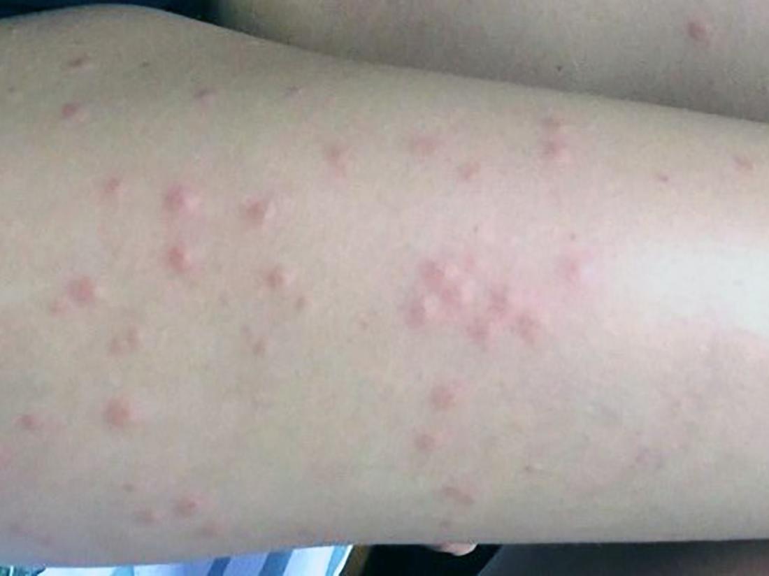 Fly bites: Pictures, symptoms, treatment