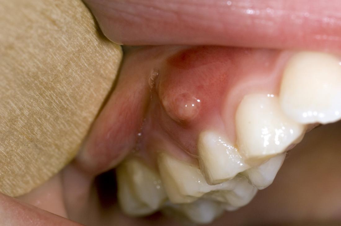 Gum Boils What They Are And How To Treat Them